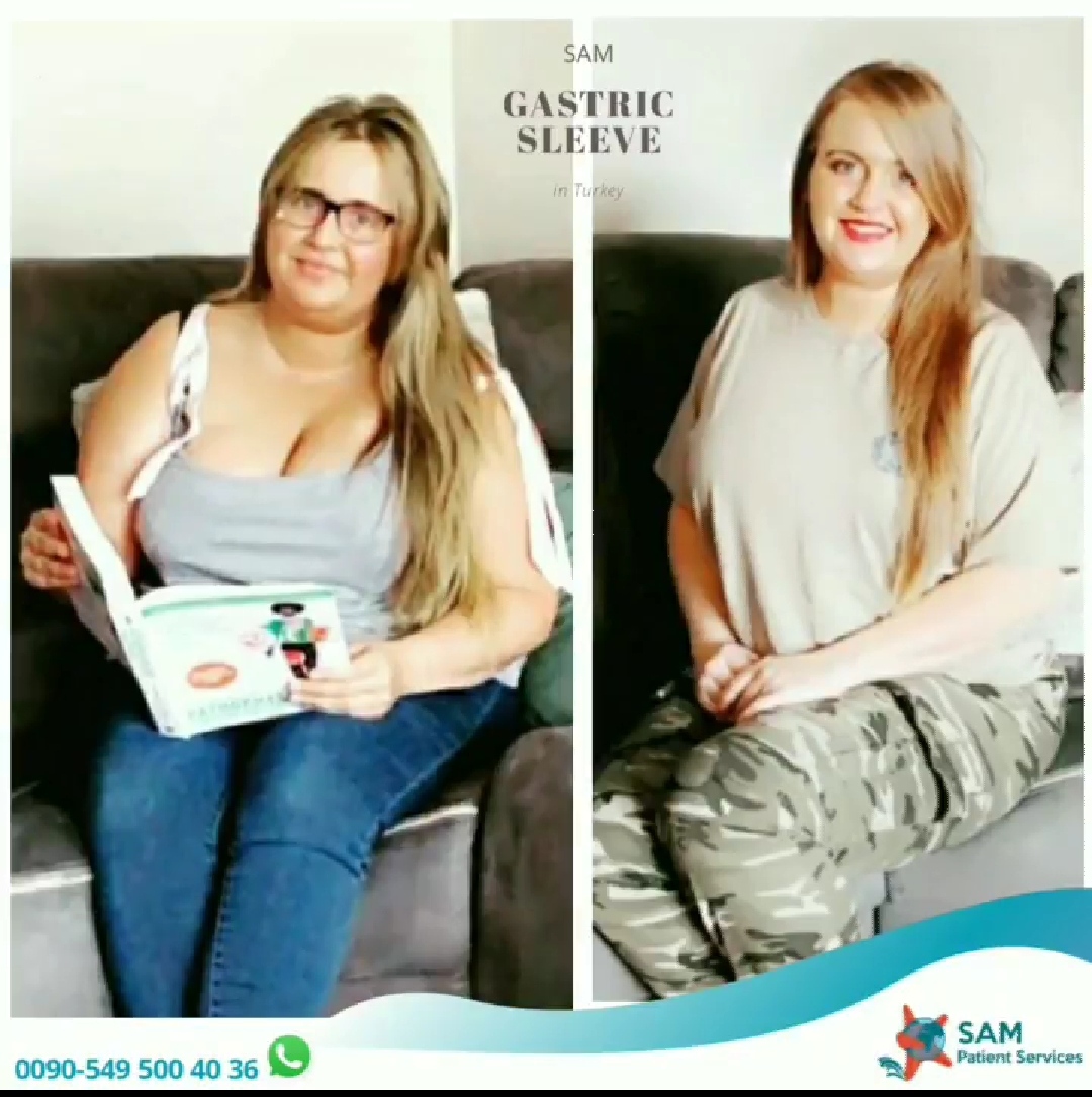 sam-patient-services-gastric-sleeve-1