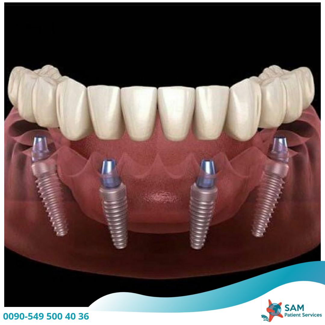 sam-patient-services-implant-applications-2